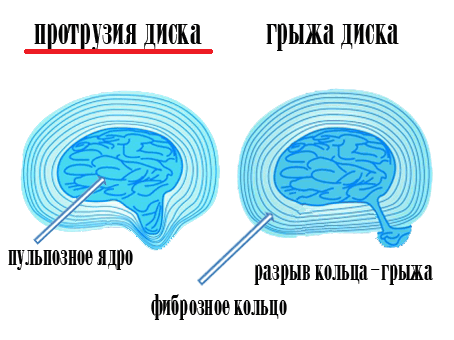 грыжа.png