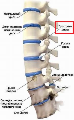 грыжа 2.jpg